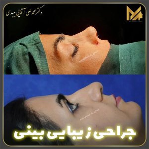 جراحی-بینی-01