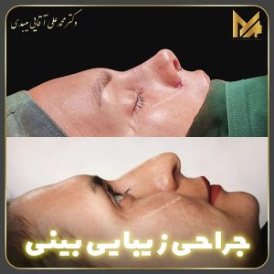 جراحی-بینی-02