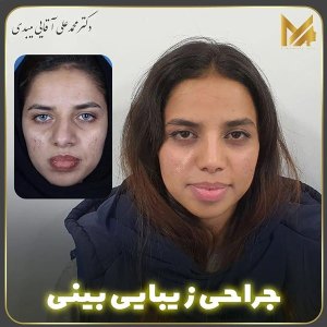 جراحی-بینی-06