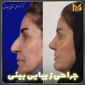 جراحی-بینی-07