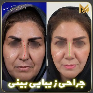 جراحی-بینی-08