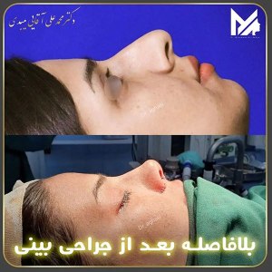 جراحی-بینی-09