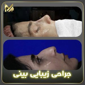جراحی-بینی-11