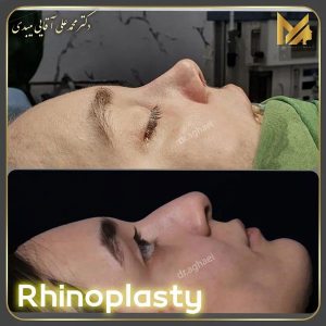 جراحی-بینی-12