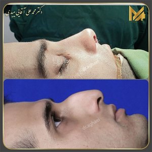 جراحی-بینی-13