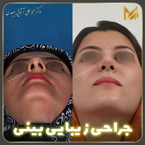 جراحی-بینی-14