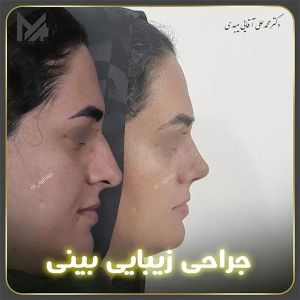 جراحی-بینی-15