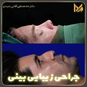 جراحی-بینی-16
