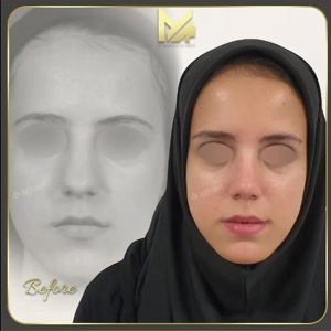 جراحی-بینی-25