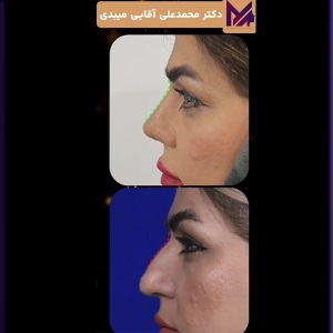 rhinopasty48