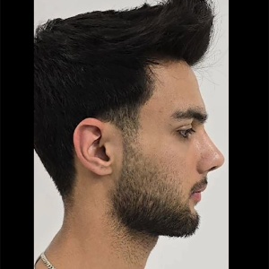 rhinoplSTY56