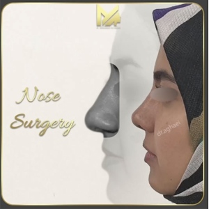 rhinoplasty-27