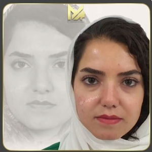 rhinoplasty-28
