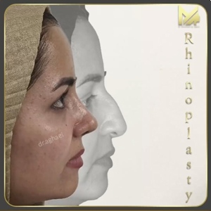rhinoplasty-30