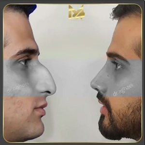 rhinoplasty-31