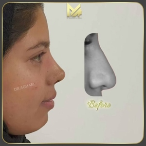 rhinoplasty-38