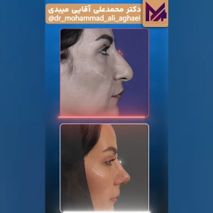 rhinoplasty-45