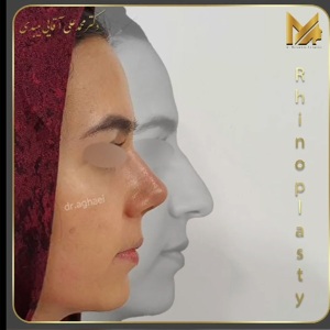 rhinoplasty-46