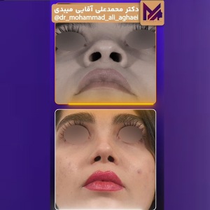 rhinoplasty-47