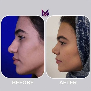 rhinoplasty-69