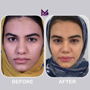 rhinoplasty-70