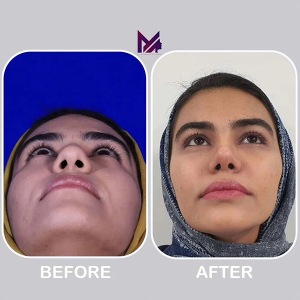 rhinoplasty-71