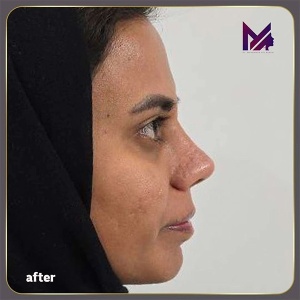 rhinoplasty-72