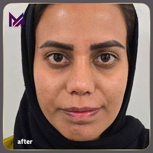 rhinoplasty-73