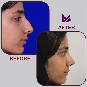 rhinoplasty-74