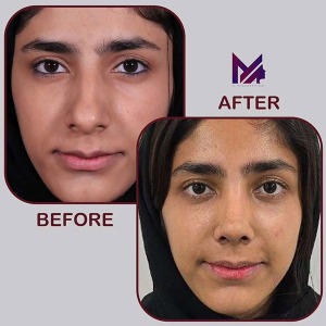 rhinoplasty-75