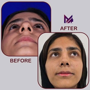 rhinoplasty-76