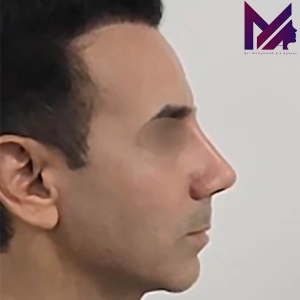 rhinoplasty-80