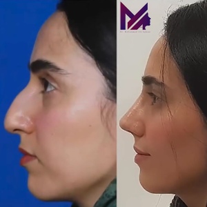 rhinoplasty-81