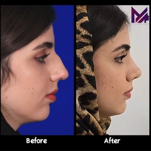 rhinoplasty-82