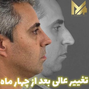 rhinoplasty-83