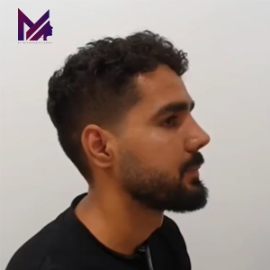 rhinoplasty-89