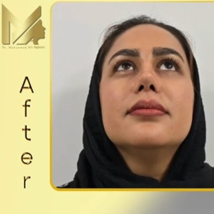 rhinoplasty-92