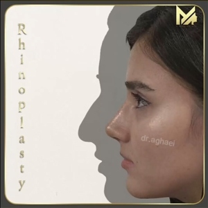 rhinoplasty32