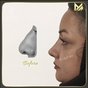 rhinoplasty33