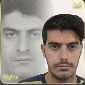 rhinoplasty34