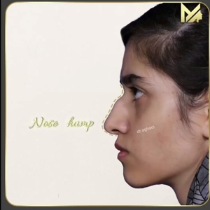 rhinoplasty35