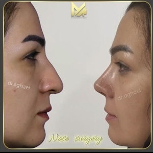 rhinoplasty36