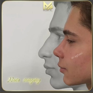 rhinoplasty37