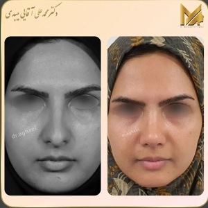 rhinoplasty39