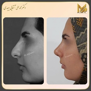 rhinoplasty40