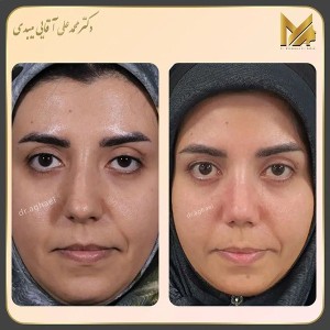 rhinoplasty41