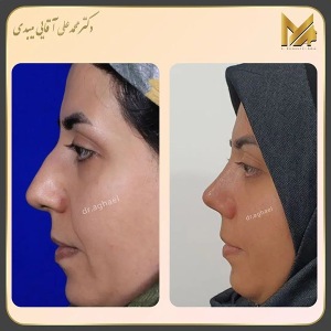 rhinoplasty42