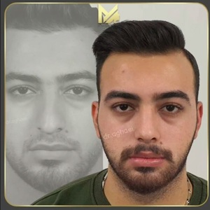 rhinoplasty43