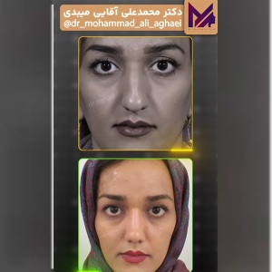 rhinoplasty44