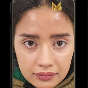 rhinoplasty49